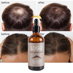 Hair Growth Oil Supplier - Organic Ginger Anti Hair Loss Treatment
