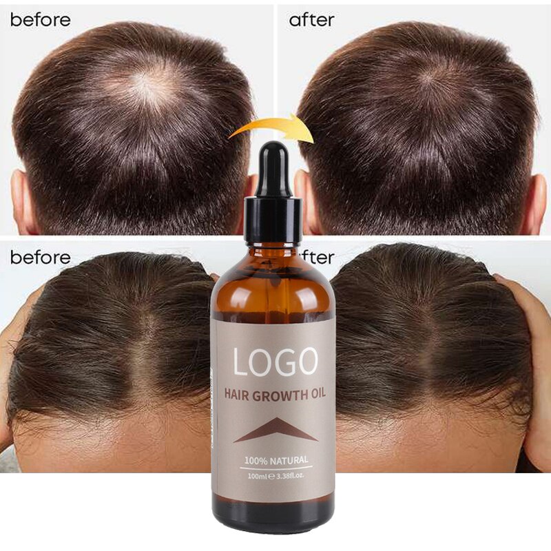 Hair Growth Oil Supplier - Organic Ginger Anti Hair Loss Treatment