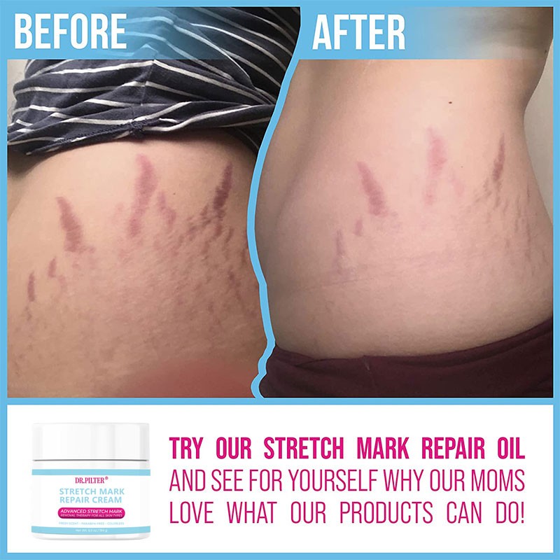 Anti Scar Cream Manufacturer - Private Label Organic Stretch Mark Removal