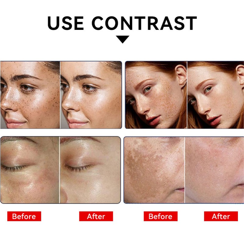 Spot Removing Cream Supplier - 7-day Quick Freckle Dark Spot Whitening