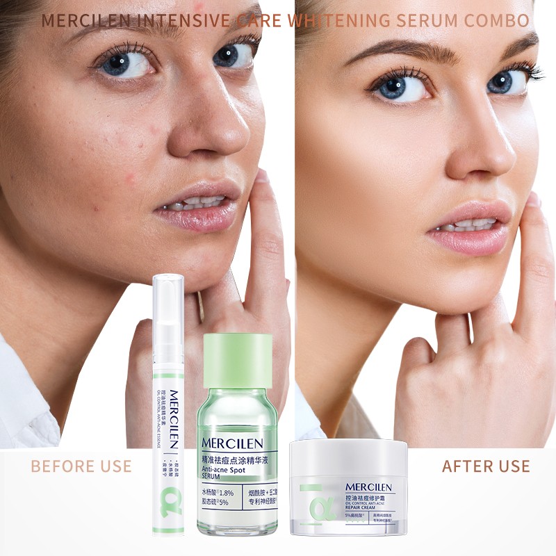 Anti-Acne Facial Skin Care Set Natural Dark Spots Pimples Remover Acne Whitening and Nourishing Tea Tree Acne Skin Care Set