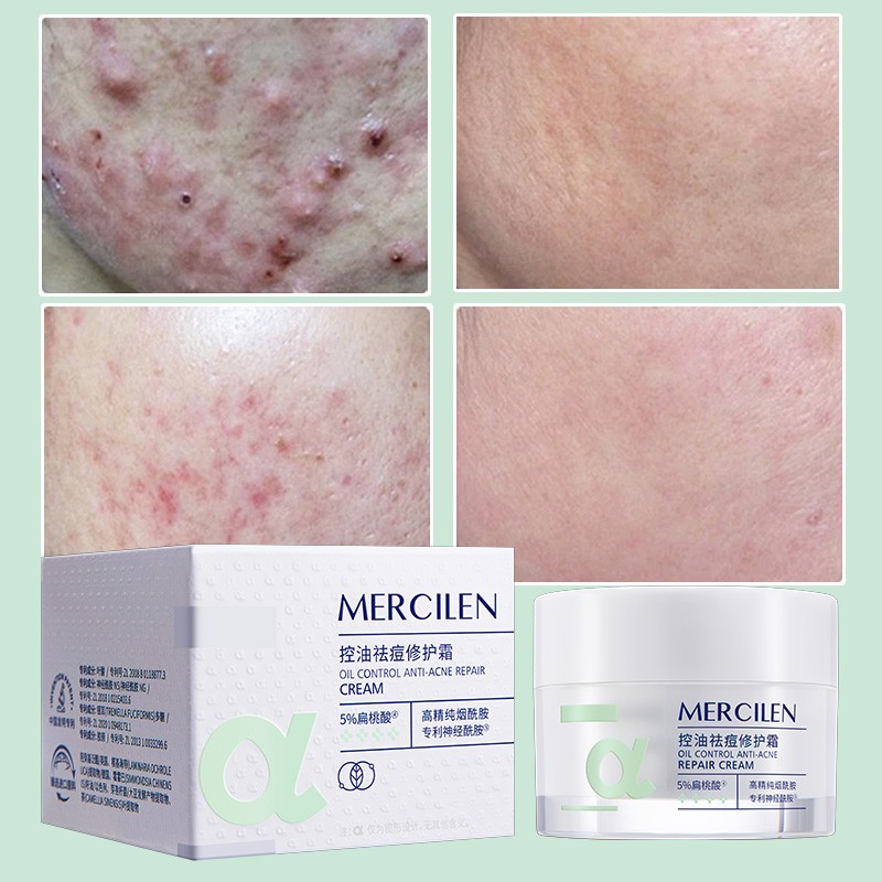 MERCILEN Acne Face Cream Lotion Salicylic Acid Dark Spot Acne Repair Essence Cream Best Pimples for Acne Pimples Face Cream