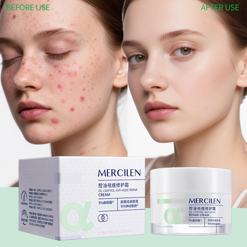 MERCILEN Acne Face Cream Lotion Salicylic Acid Dark Spot Acne Repair Essence Cream Best Pimples for Acne Pimples Face Cream