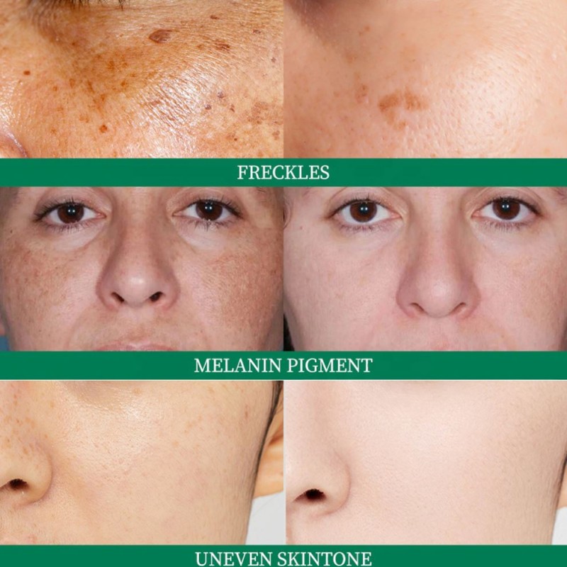 Vitamin C Lightens Skin Dark Spot Remover Cream Inhibits Melanin Pigmentation Blemish Whitening Cream Freckles Removal Cream