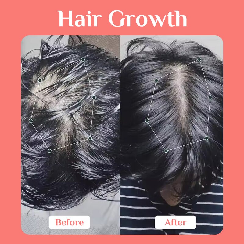 5% Redensyl Hair Growth Spray Manufacturer - Bulk Custom