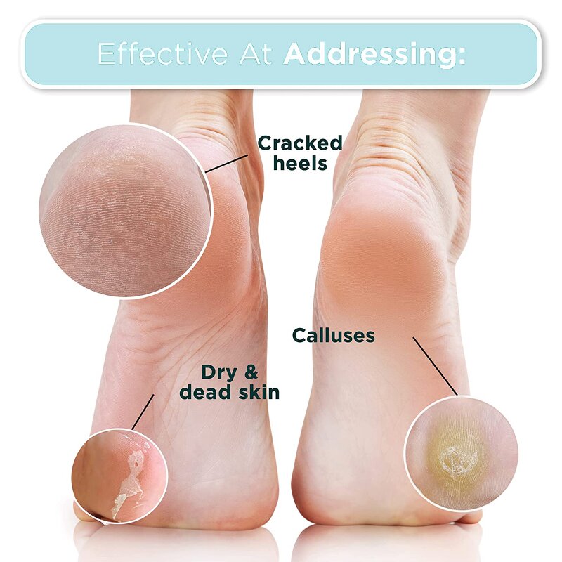 Foot Peel Mask Supplier - Wholesale Callus Remover for Men Women