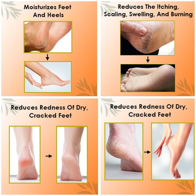 Foot Balm Manufacturer - Repair Dry Cracked Skin Urea Cream Stick