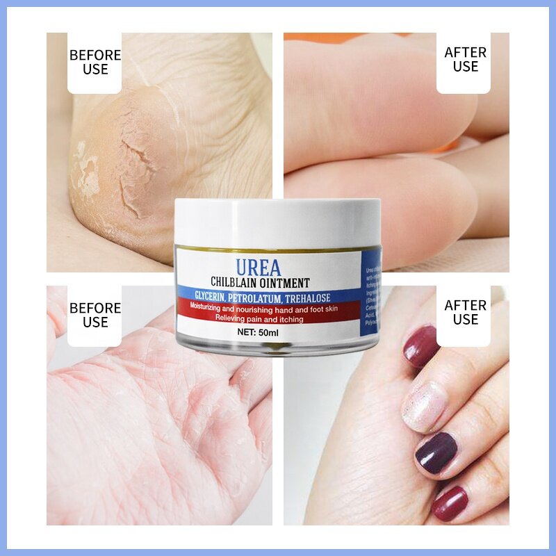 Foot Cream Factory - OEM Urea Chilblain Ointment Moisturizing