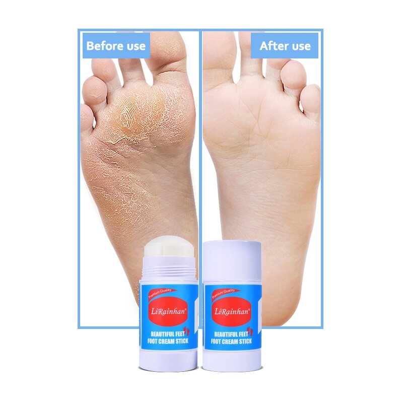 Foot Balm Manufacturer - Repair Dry Cracked Skin Urea Cream Stick