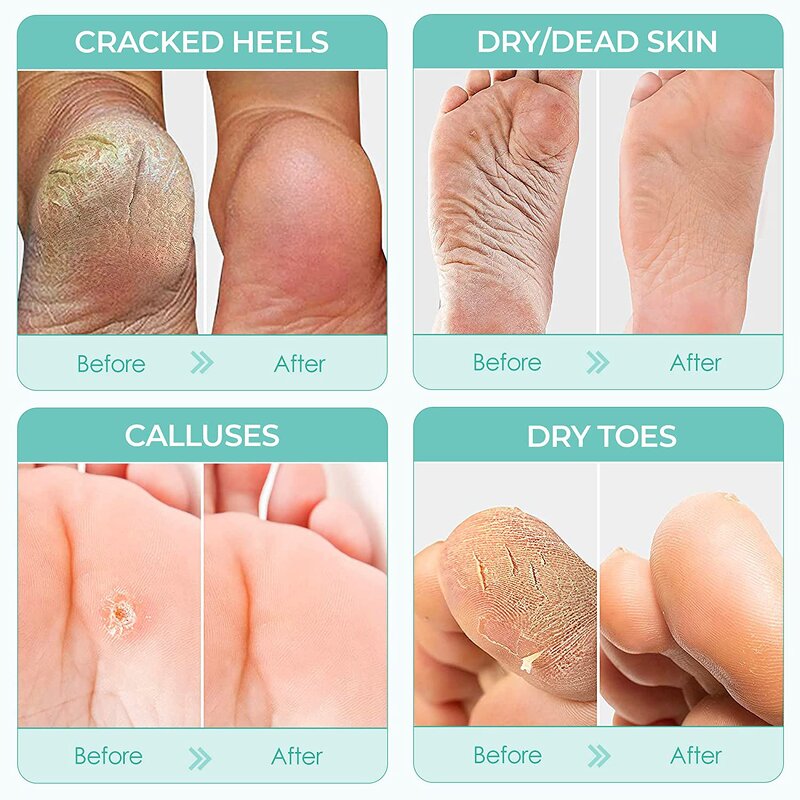 Foot Peel Mask Supplier - Natural Safe Botanical Extracts