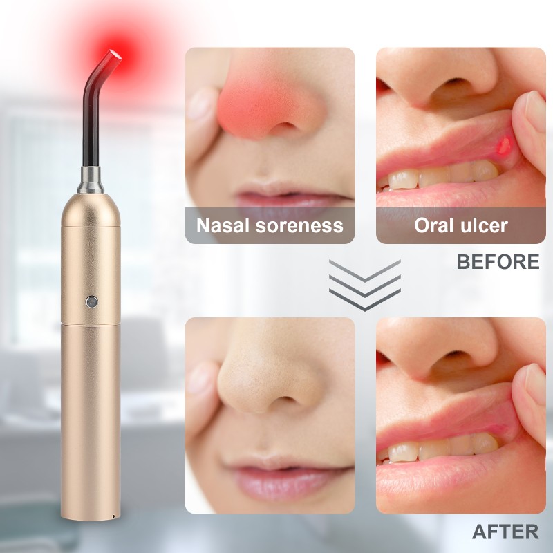 Kinreen 5 Pieces Led Torch Blue Light  Infrared Lamp Portable Built in Battery for Skin Care Device Treatment Torch