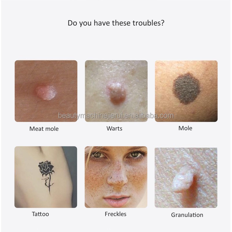 Portable Home Picosecond Laser Tattoo Removal/ Tattoo Freckle Removal Mole Dark Spot Laser Pen