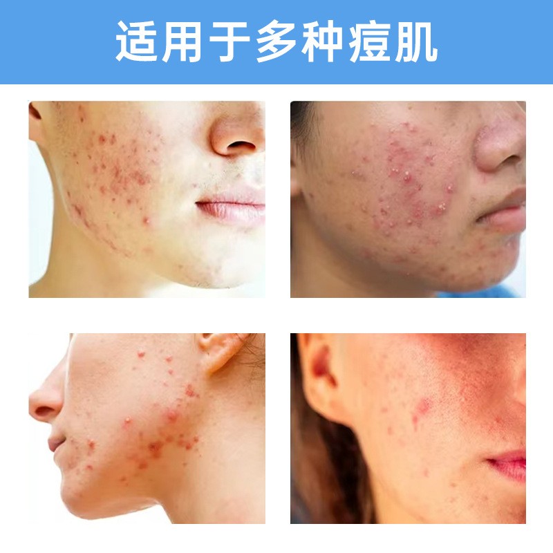 Colorful Acne Patch Love Heart Pentagram Concealer Acne Patch Hydrocolloid Acne Pimple Marks Covering Patch