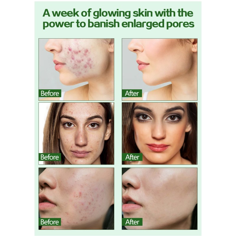 Organic Plant Extract Skin Whitening and Moisturizing Tea Tree Essence Oil Face Anti-Acne Control Pore-Glow Face Essence