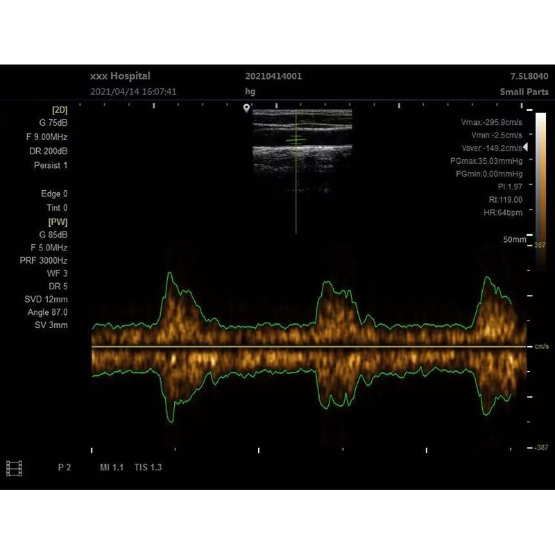 Laptop Ultrasound Scanner Factory - New B/W Device Portable with PW/ IMT