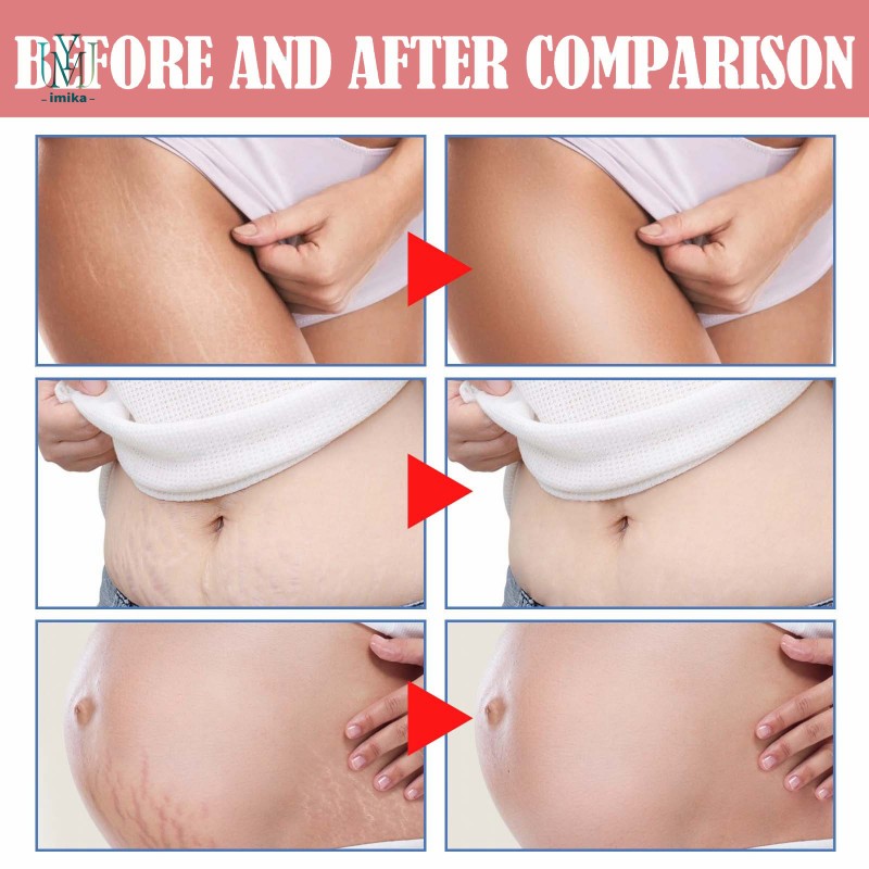 Natural Stretch Mark Repair Cream Effective Skin Repairing Gel Stretch Marks Scar Removing Cream