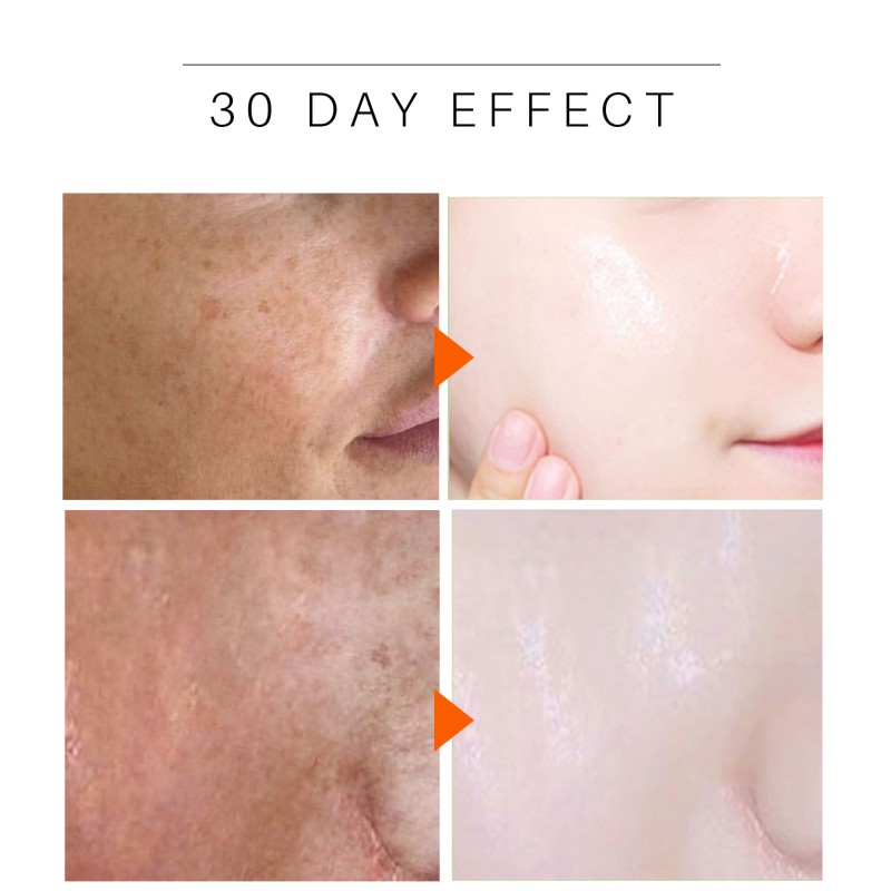 Lanthome Herbal Face Cream Whitening and Acne Removal Pimple Face Brightening Anti Acne Tumeric Cream