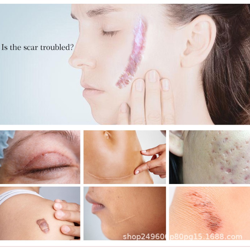 Yoxier Lavender Scar Repair Cream Removes Acne Marks Whitening Cream Skin Care