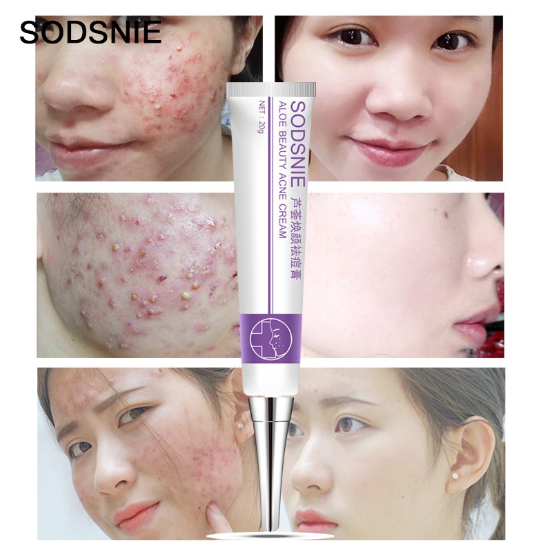 Aloe Q Acne Cream Facial Skin Care Products  Hydrating Cream