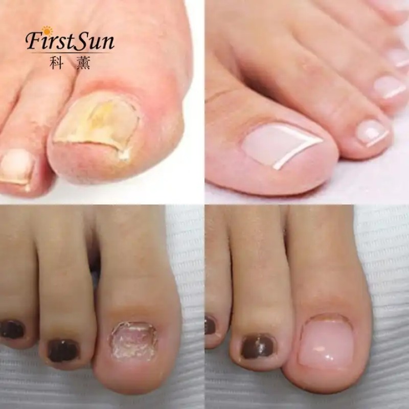 Bright Nail Armor Repair Gel for Foot Care Anti-Infection Onychomycosis Fungal Nail Treatment Cream Effective Nail Repair