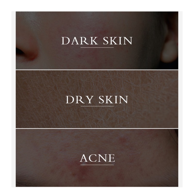 Lanthome Herbal Face Cream Whitening and Acne Removal Pimple Face Brightening Anti Acne Tumeric Cream