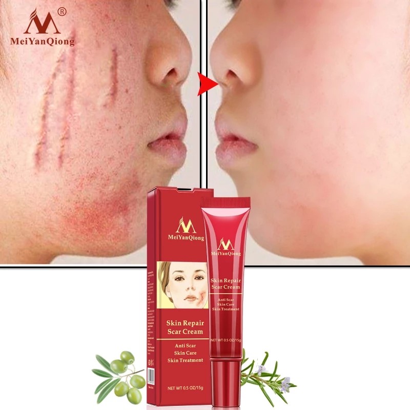 Hot Sale Skin Care Anti Scar  for Old Scars on Legs and Face