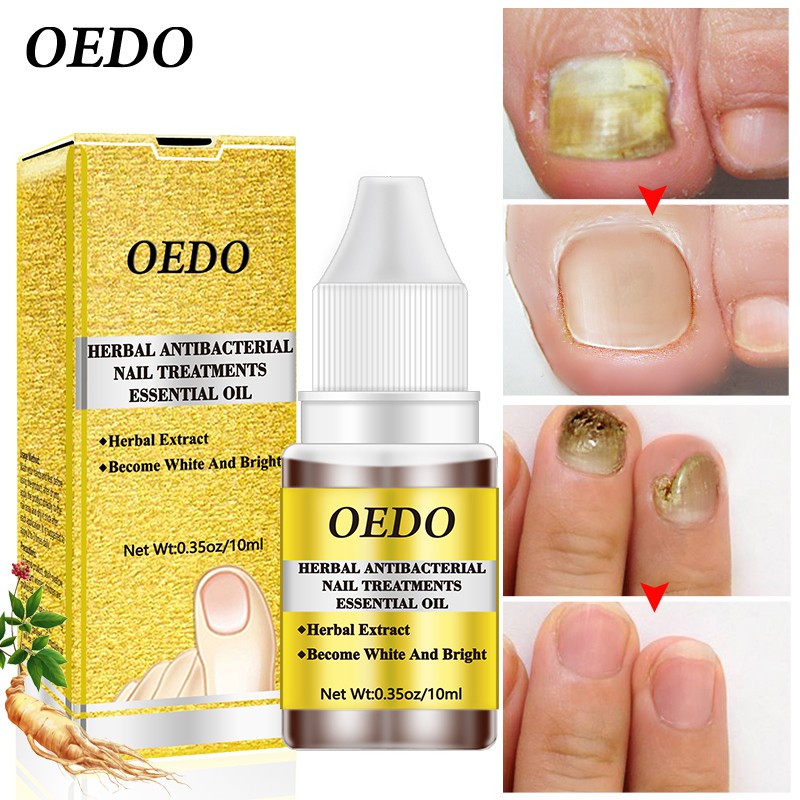 Wholesale Nail Foot Care Effective Natural Treatment for Fungal Nail