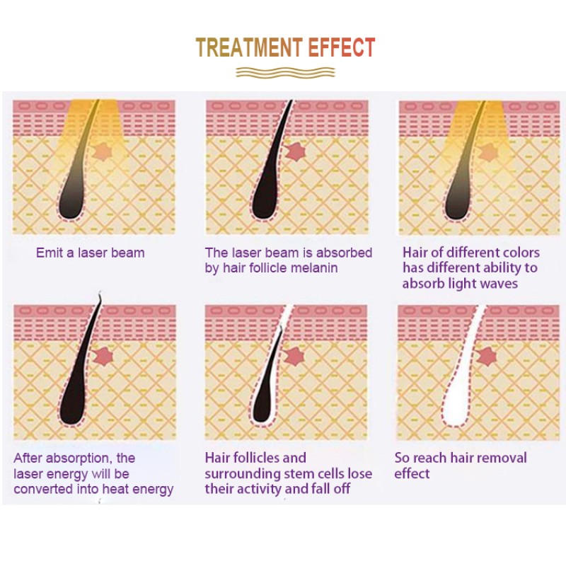 Hot-selling Laser Beauty Equipment 3 Wavelength 808 Diode Laser Hair Removal Machine for Salon Beauty Clinic Home Use