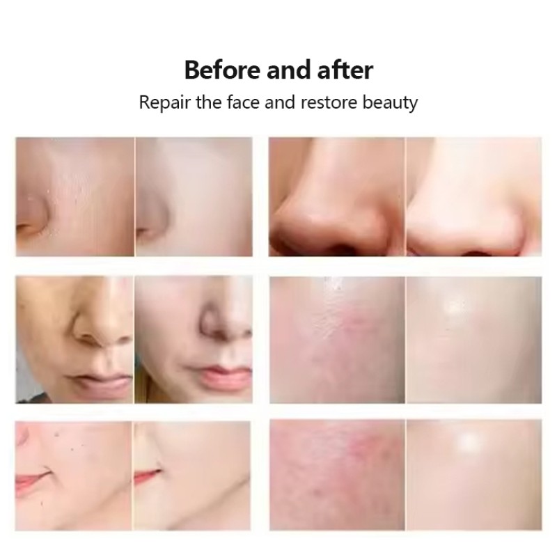 Acne Spot Treatment Anti Acne Treatment Skin Care Products Facial Machine for Beauty Salon Use
