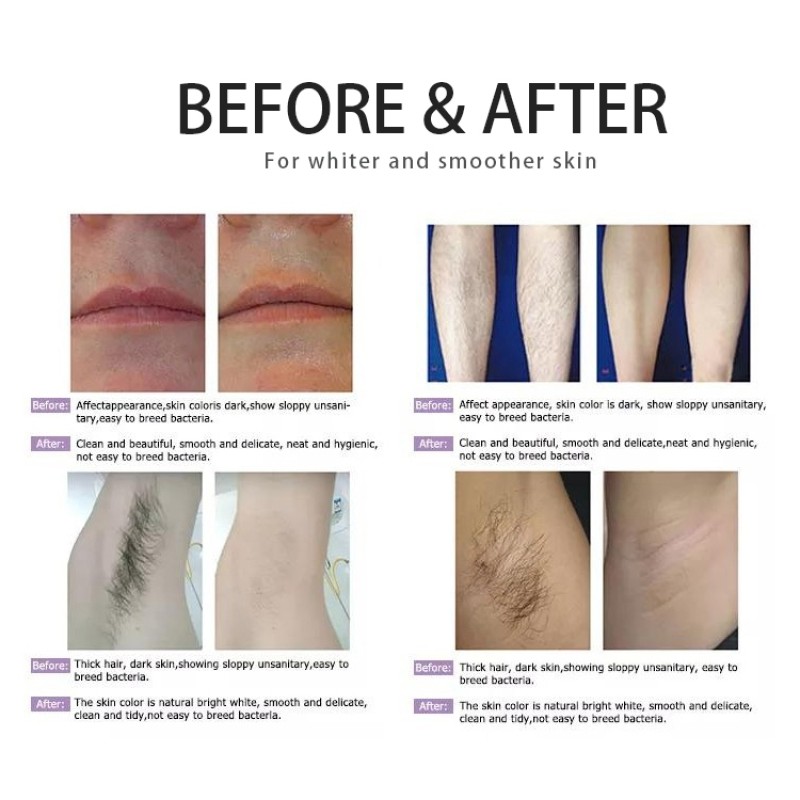 2025 Newest Diode Laser 755 810 1064nm Hair Removal Machine Skin Rejuvenation Machine Portable