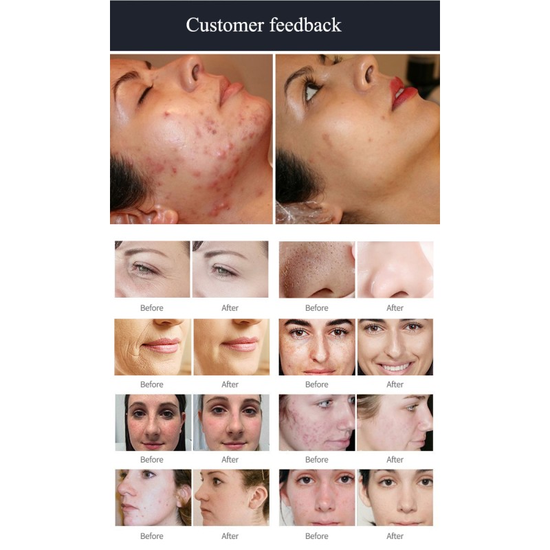 Ice Blue Pro Hydraskin Dermabrasion Skin Rejuvenation Machine Smart Ice Blue Machine Intelligent With Skin Analyzer Machine