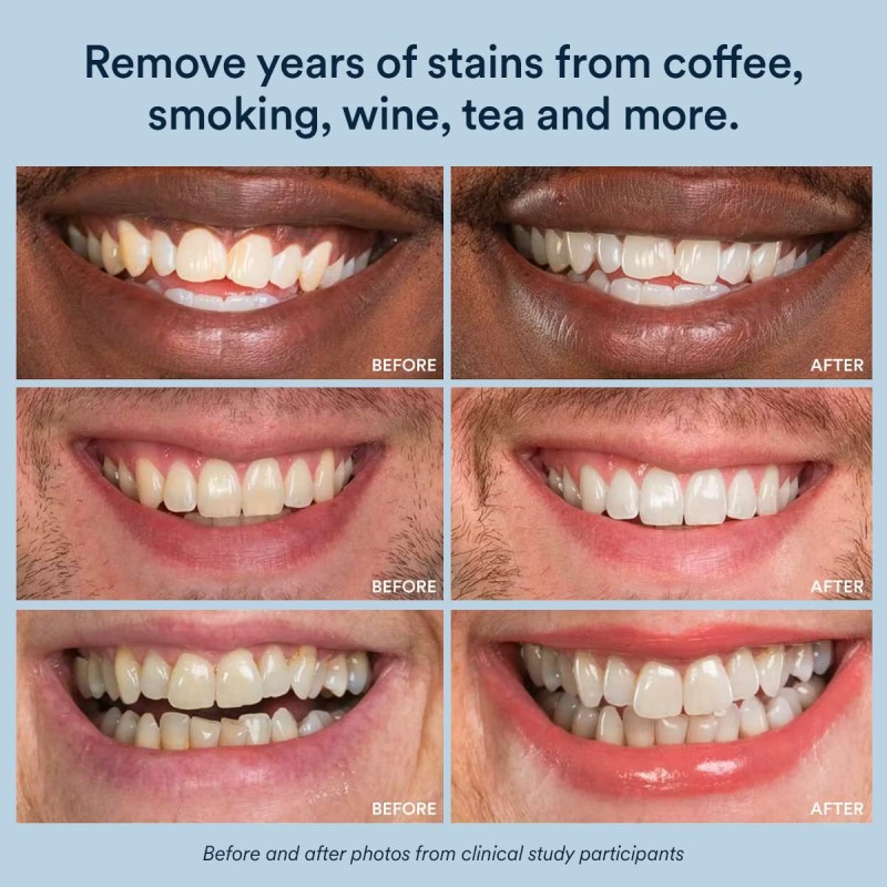 Professional Teeth Whitening Strips  Oral Hygiene at Home Teeth Whitener Dental Strips 7pairs Whitening Teeth Strips