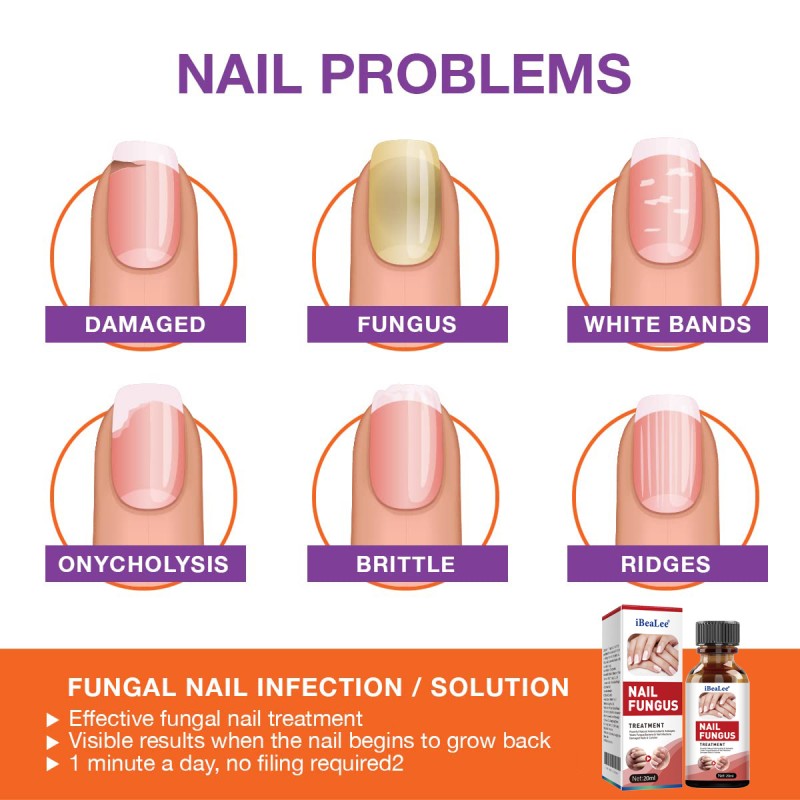 Nail Repair Pen Factory - OEM Toenail Fingernail Fungus Treatment
