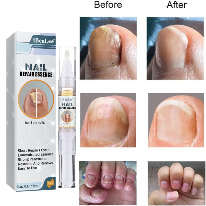 Nail Strengthener Manufacturer - Custom Hand Foot Cracked Nail Care