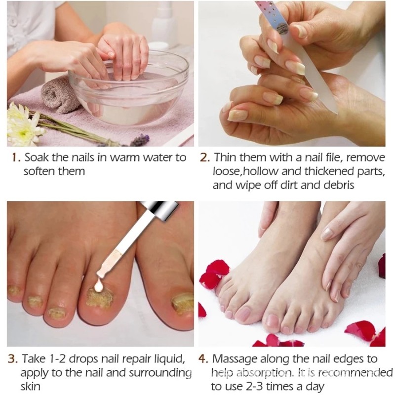 Nail Treatment Device Supplier - Bulk Toenail Fingernail Fungal Care