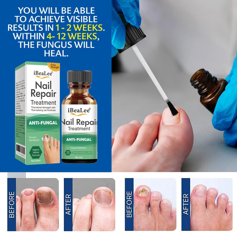 Nail Fungus Treatment Supplier - Bulk Restore Renews Kills Fungus