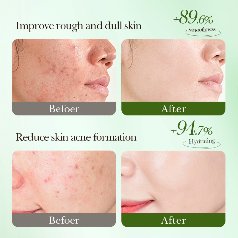 Acne Serum Manufacturer - Custom Salicylic Acid Hydrating Acne Relief