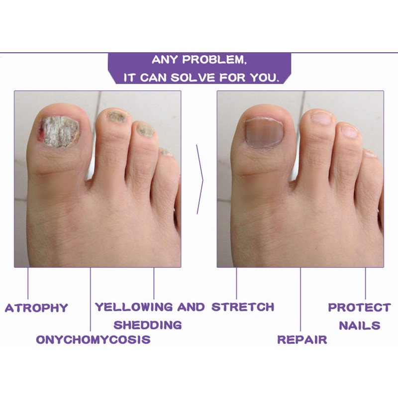 Nail Treatment Device Supplier - Bulk Toenail Fingernail Fungal Care