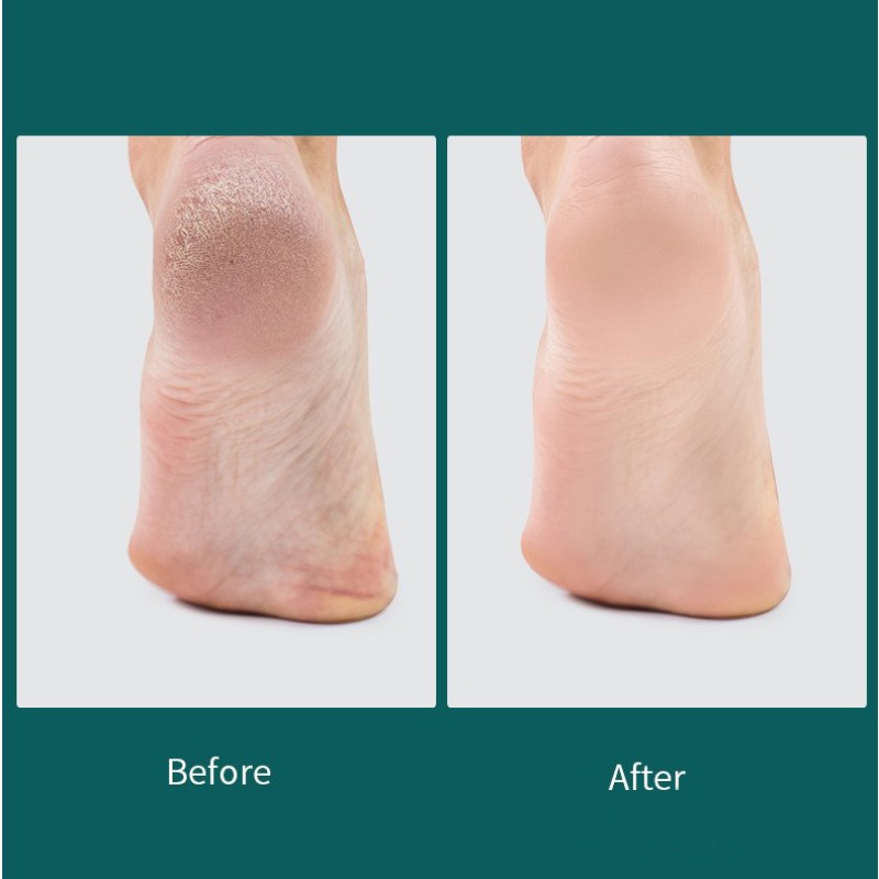 Callus Remover Supplier - Bulk Stainless Steel Foot File