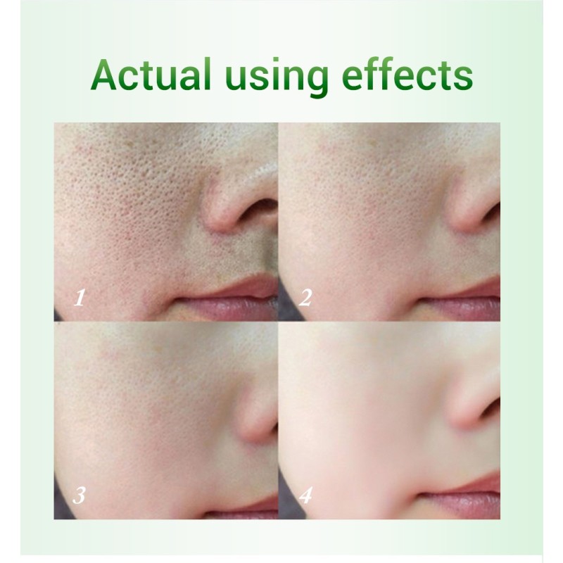 Scar Repair Lotion Manufacturer - Tea Tree Anti-Pimple Pigment Removal