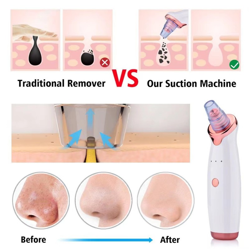 Blackhead Remover Factory - Facial Pore Cleaner Vacuum Comedone Extractor
