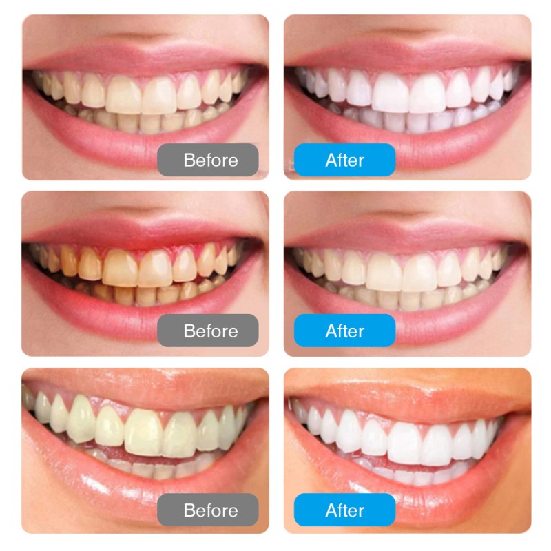 Tooth Whitener Manufacturer - OEM Dental Care Charcoal Whitening