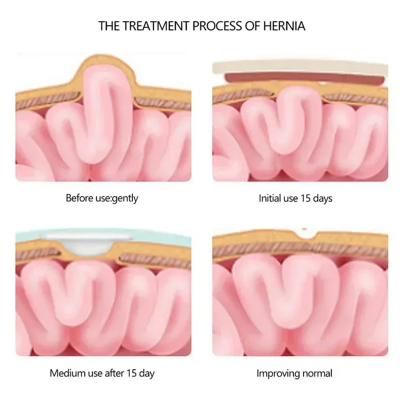 Infant Hernia Belt Manufacturer - OEM Breathable Cotton Therapy Belt