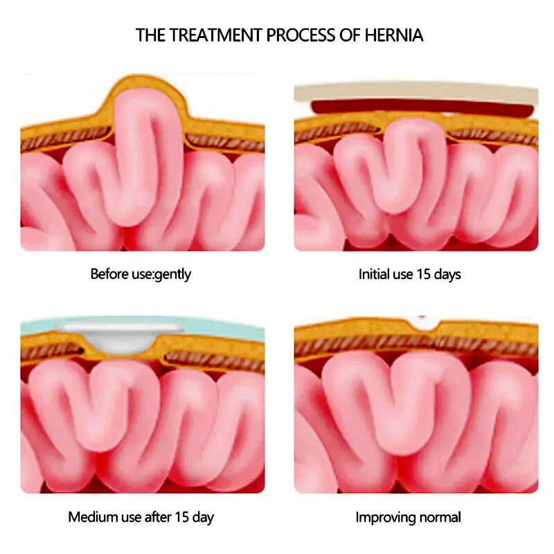 Baby Hernia Patch Supplier - OEM Waterproof Cotton Navel Patches