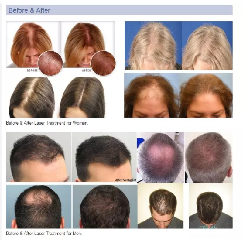 Laser Hat Manufacturer - Bulk Home Use Cool Lifting Skin Care