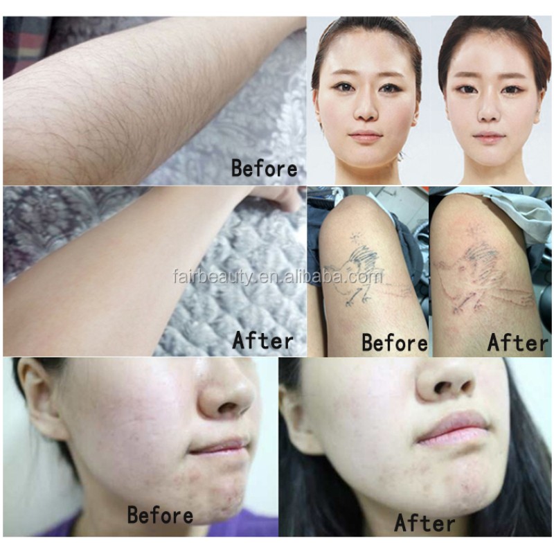 Diode Laser Supplier - Bulk Factory Price 755 808 1064nm Tattoo