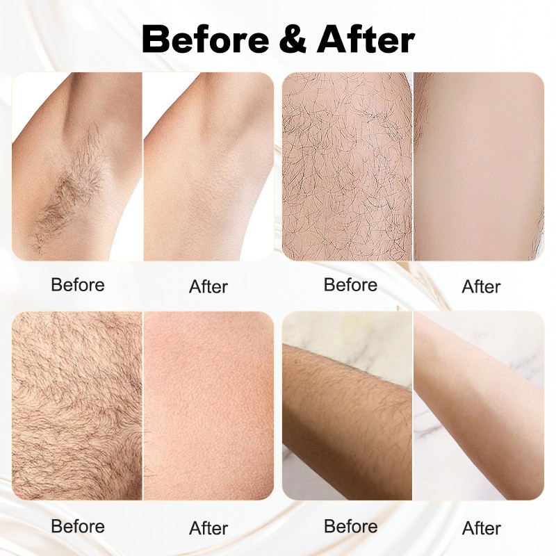 Hair Removal Machine Manufacturer - OEM Skin Rejuvenation Permanent OPT