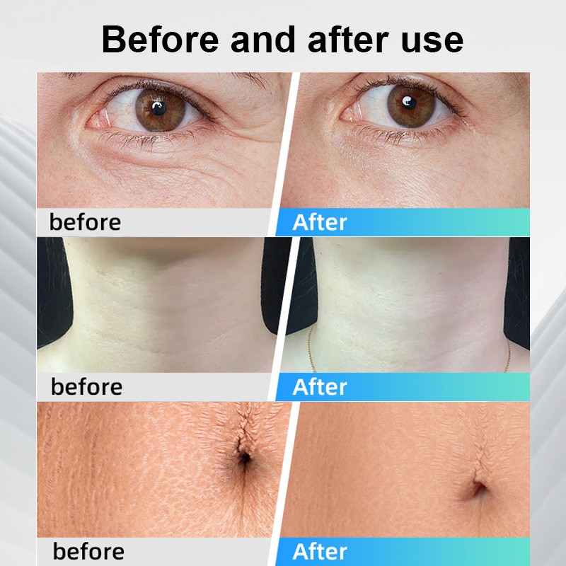 Physio Therapy Machine Supplier - OEM 448khz Pain Relief RF Massager