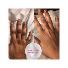 Dark Spot Corrector Manufacturer - Bulk Elbows Knuckles Pigmentation Remover