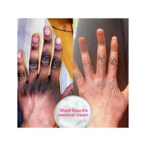 Melasma Treatment Cream Factory - Bulk Anti Melasma Face Whitening Formula